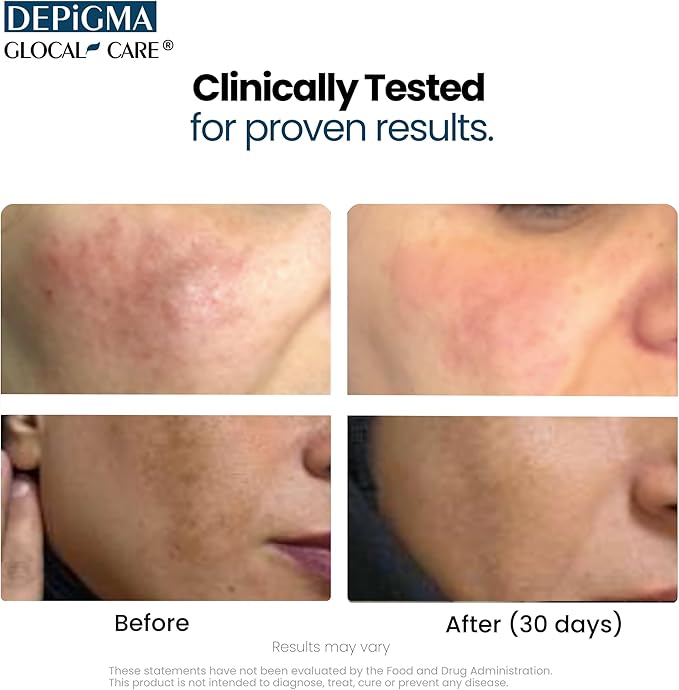 GlocalCare Depigma Support Reduction of Hyperpigmentation, Melasma & Dark Spots with Glutathione, Polypodium Leucotomos, Grape Seed & Marigold Extract-VivaGrace Women