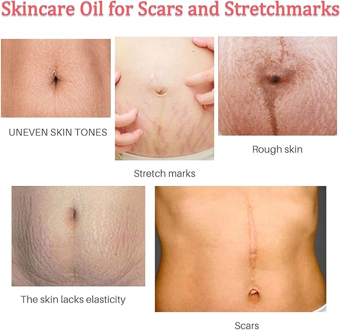 Stretch Mark Pregnancy Massage Oil, Stretch Mark Oil, Skincare Oil for Improve Stretchmarks, Pregnancy Skin Care Fade Stretch Marks, Body Moisturizer for Dry Skin, First Time Mom Gift 30 ml-VivaGrace Women