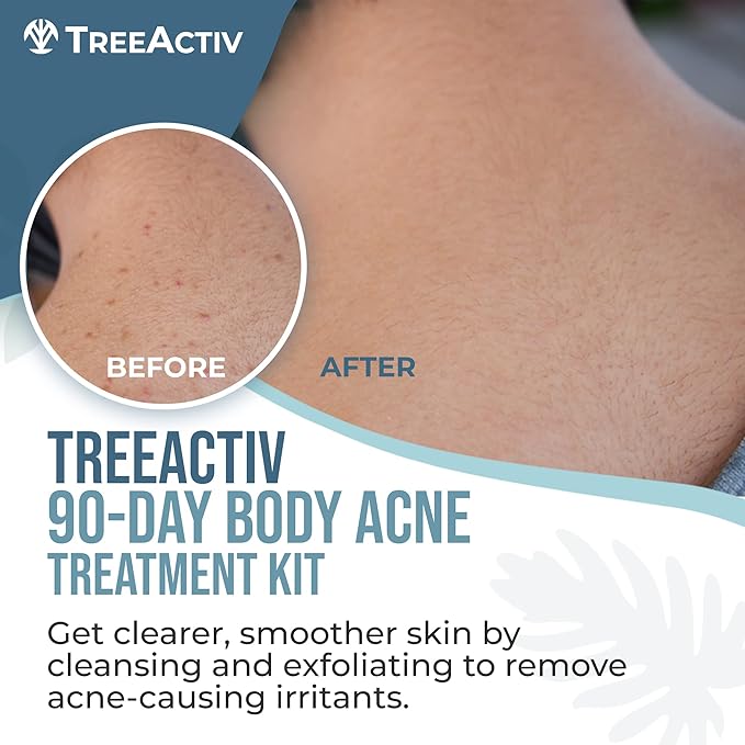 TreeActiv 90-Day Body Acne Treatment Kit, Salicylic Acid Acne Body Spray, Exfoliating Body Acne Wash, Body Acne Treatment for Back, Chest and Butt Acne Removal, Back Acne Treatment For Women and Men-VivaGrace Women