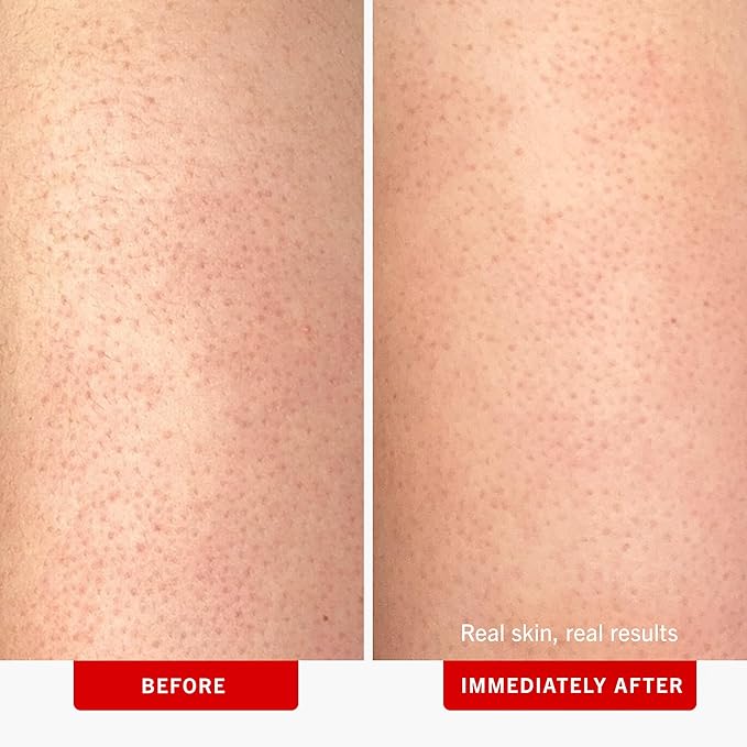 First Aid Beauty - KP Bump Eraser Body Scrub with 10% AHA, Keratosis Pilaris Skin Exfoliater with Glycolic and Lactic acids, Helps Reduce Chicken Skin Bumps, Safe for Sensitive Skin, 4 oz-VivaGrace Women
