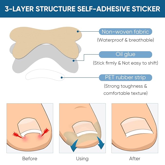 Ingrown Toenail Treatment, 60Pcs Ingrown Toenail Corrector Strips, Ingrown Toenail Removal Kit with File and Lifter, 60Pcs-VivaGrace Women