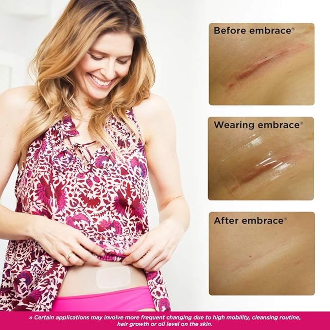 Embrace Active Scar Defense for New Scars, FDA-Cleared Silicone Scar Sheets, 2.4 Inch, Medium, 60 Day Supply (Recommended Treatment)-VivaGrace Women