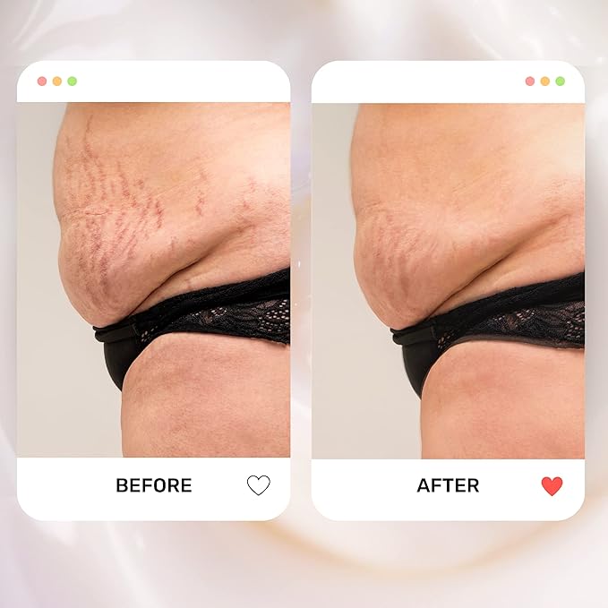 S1 Stretch Mark Cream, 150ml / 5oz, Lightweight Pregnancy Stretch Mark Cream-VivaGrace Women