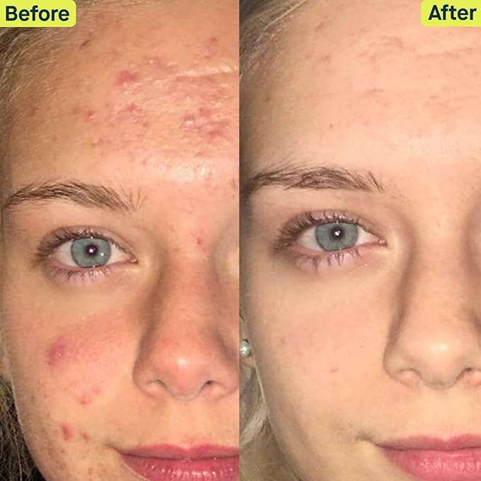 SLMD Skincare by Dr. Pimple Popper - 30-Day Acne System - 4-pc Kit - 3 Steps, 2x per Day Full Routine to Treat and Prevent All Stages of Acne-VivaGrace Women