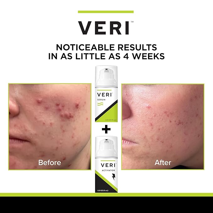 VERI Nitric Oxide + Salicylic Acid Clear Skin System (Peroxide-Free): For Acne Prone Skin, Unclogs Pores, Clarifies Blemishes, Reduces Inflammation, Prevent Future Breakouts, 30 mL / 1 oz-VivaGrace Women