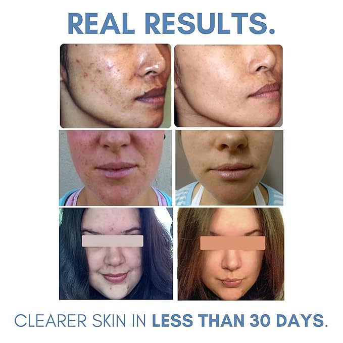 Clarifying Toner for Acne and Blemishes, Face Toner, Facial Toner, Skin Toner, Acne Toner, Toner Oily Skin, Salicylic Acid Toner, Astringent for Face, Toners, 4 Fl Oz-VivaGrace Women