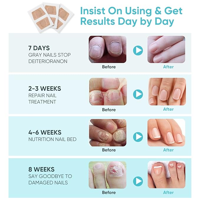 Toenail Repair Treatment, 16Pcs Nail Repair Treatment Extra Strength, Restores Health Appearance of Discolored or Damaged Nails, Comfortable & Convenient-VivaGrace Women