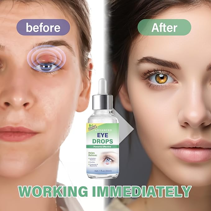 Stye Eye Treatment, Stye Eye Drops Serum for Styes Chalazion and Blepharitis, Chalazion Remover Fast Relief, Restore Healthier Eye Skin, 30ml-VivaGrace Women