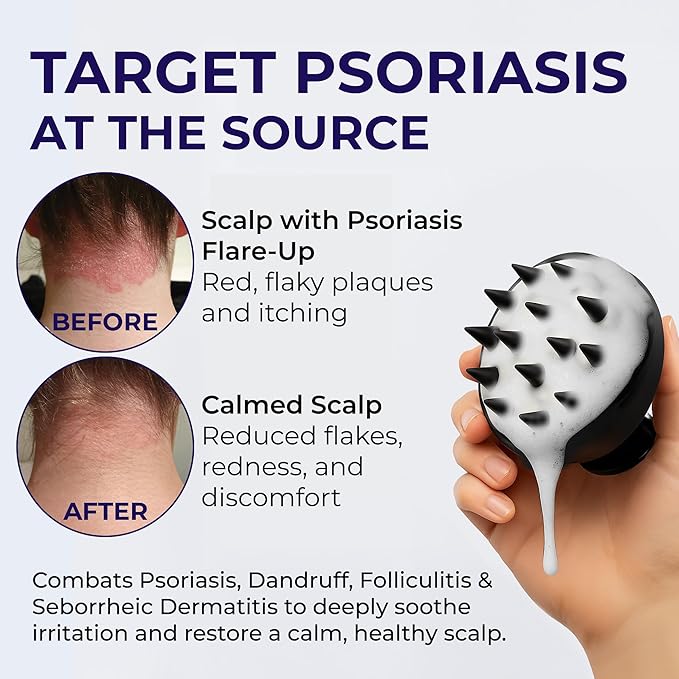 Scalp Psoriasis Shampoo, Flakes Shampoo Anti Dandruff, Itchy Scalp Treatment for Seborrheic Dermatitis & Folliculitis, Anti Fungal, Medicated Solution for Itchy, Flaky & Dry Hairs-VivaGrace Women