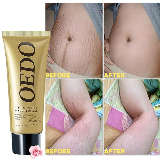Rose Remove Stretch Marks Cream for Pregnancy Scar Removal Cream Natural Plant Essence Formula Prevention Remove Stretch Mark Old Scars Body Moisturizer 40g-VivaGrace Women