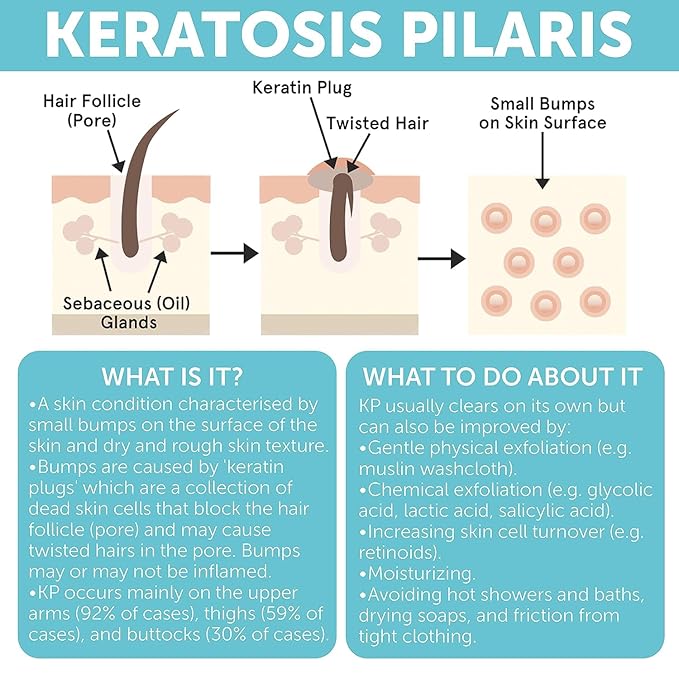 Body Soap for Keratosis Pilaris | Exfoliating Soap Scrub with 10% AHA & Micro Pumice Beads | Buffingbar for Smooth Skin, Strawberry Legs, Ingrown Hair & Razor Bumps | Bar Soap for Men and Women 4.2 oz