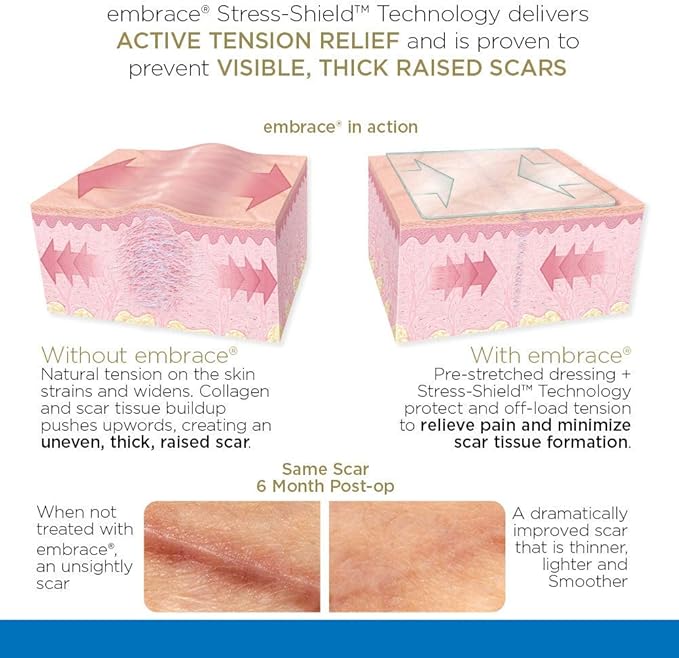 Embrace Active Scar Defense for New Scars, FDA-Cleared Medical-Grade Silicone Scar Sheets for Hypertrophic & Keloid Scar Treatment, 4.7 Inch, Large, 30-Day Supply-VivaGrace Women