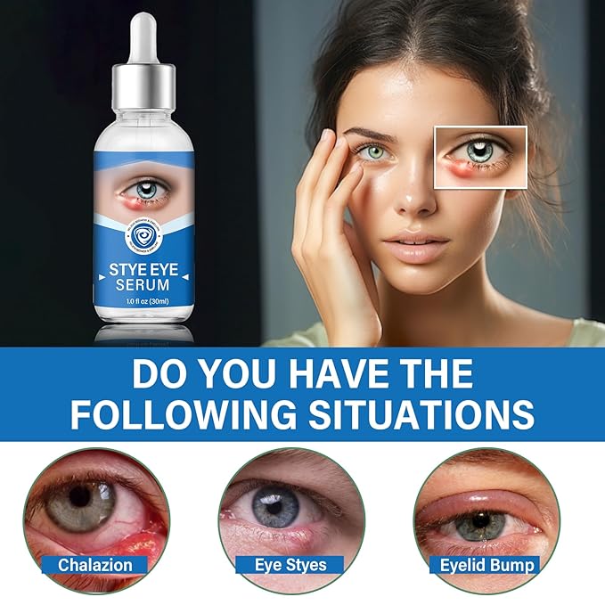 Stye Eye Treatment, Stye Eye Serum for Styes Chalazion and Blepharitis, Gently Cleanses Lashes and Eyes, Restore Healthier Eye Skin, 1 Fl.oz-VivaGrace Women
