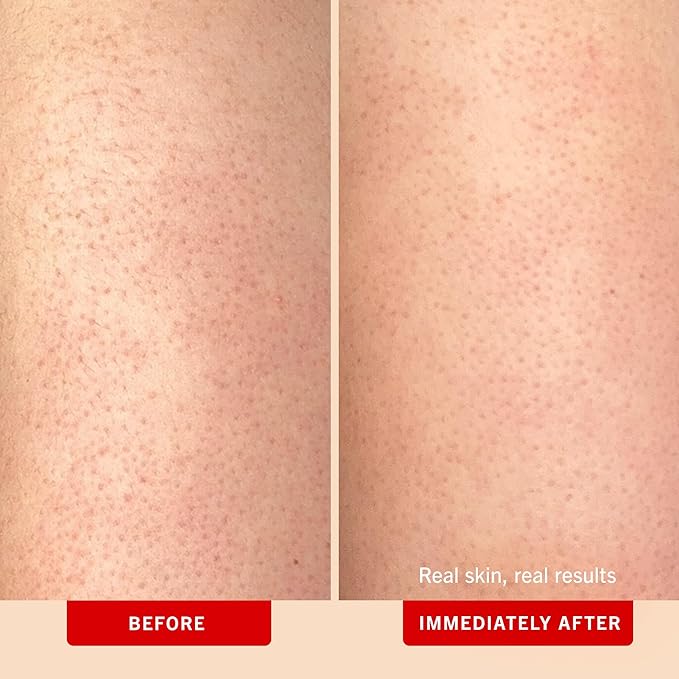 First Aid Beauty - KP Bump Eraser Body Scrub with 10% AHA, Keratosis Pilaris Exfoliator with Glycolic and Lactic acids, Helps Reduce Chicken Skin Bumps, Safe for Sensitive Skin, Peach Scent (8 oz)-VivaGrace Women