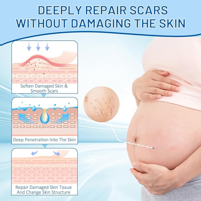 Stretch Mark Removal, Stretch Mark Cream for Pregnancy, Scar Removal Cream Deep Stretch Mark Removal, Belly Butter for Pregnant Women To Prevent And Repair Maternity Stretch Marks Scar 2.82 Oz-VivaGrace Women