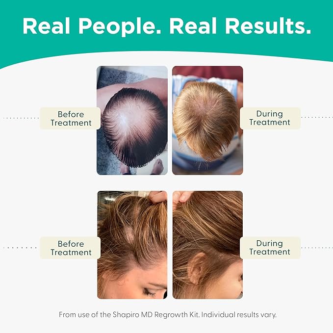 Shapiro MD Hair Growth Experts Hair Loss Shampoo and Conditioner, DHT Fighting Vegan Formula for Thinning Hair Developed by Dermatologists, Experience Healthier, Fuller Thicker Hair, 4 Month Supply-VivaGrace Women
