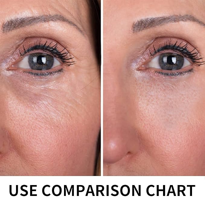 Pdo Threads Lift for Eyes, Pdo Lifting Thread, Improves Wrinkles And Sagging Around The Eye Area (20PCS-30G*38MM)-VivaGrace Women