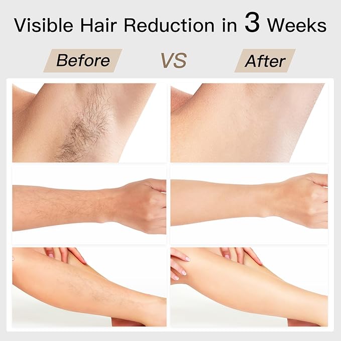 Laser Hair Removal, BoSidin IPL Hair Removal with Painless Ice-Cooling, 2-in-1 Face SR Rejuvenation, 6+1 Modes, 6 Levels Hair Removal for Women Permanent, Laser Hair Removal Kit with Shaver, Goggles-VivaGrace Women