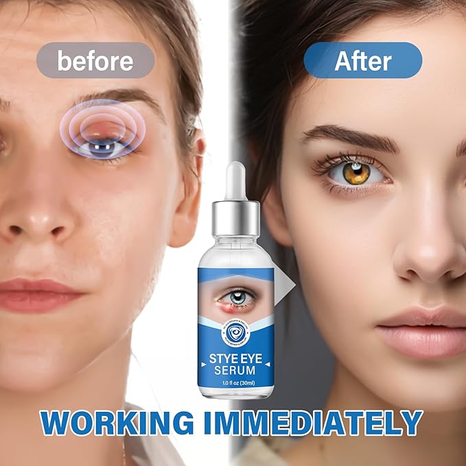 Stye Eye Treatment, Stye Eye Serum for Styes Chalazion and Blepharitis, Gently Cleanses Lashes and Eyes, Restore Healthier Eye Skin, 1 Fl.oz-VivaGrace Women