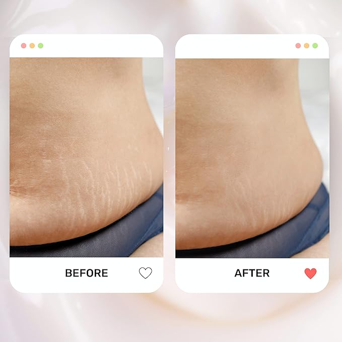 S1 Stretch Mark Cream, 150ml / 5oz, Lightweight Pregnancy Stretch Mark Cream-VivaGrace Women