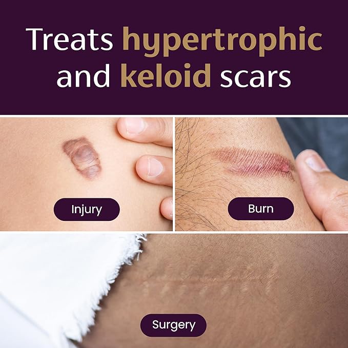 Mederma Medical Grade Silicone Scar Sheets; Improves The Appearance of Old and New Scars; for Injury, Burn and Surgery Scars, 4 Count-VivaGrace Women