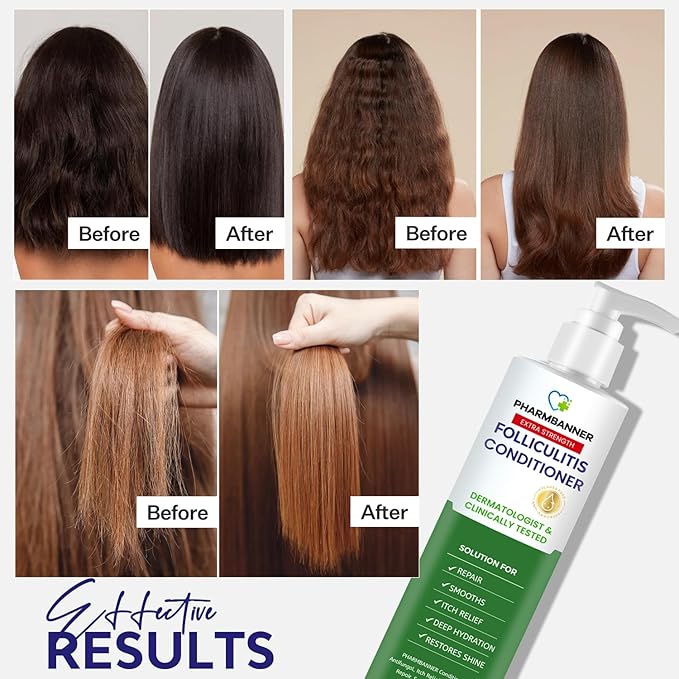 Folliculitis Itch Relief Conditioner: Tea Tree Oil & Moroccan Argan Oil - Deep Hydration & Repair - Nourishes, Smooths, Restores Shine - Safe for Dry or Damaged Hair-11.84 oz-VivaGrace Women