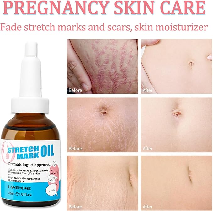 Stretch Mark Pregnancy Massage Oil, Stretch Mark Oil, Skincare Oil for Improve Stretchmarks, Pregnancy Skin Care Fade Stretch Marks, Body Moisturizer for Dry Skin, First Time Mom Gift 30 ml-VivaGrace Women