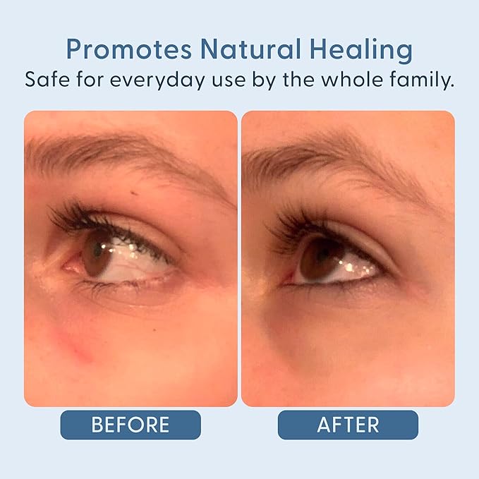 twenty/twenty Easy On The Eyes – 0.02% Hypochlorous Acid Spray to Cleanse Eyelashes – Reduce Eyelid Irritation – Safe for Sensitive Skin – Ophthalmologist Developed–Vegan, Clean Ingredients – 60ml-VivaGrace Women