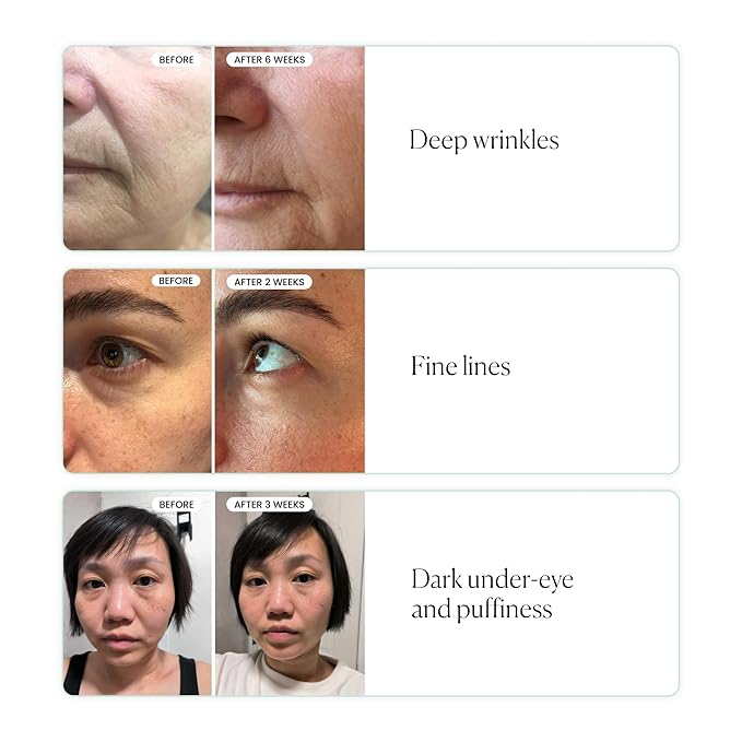 Qure Skincare MicroInfusion Targeted Patches - 8 Pairs of Targeted Under Eye Patches Formulated for Fine Lines & Wrinkles - Retinol, Caffeine, Niacinamide & Peptides - Dissolvable for Overnight Use-VivaGrace Women