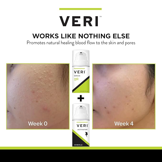 VERI Nitric Oxide + Salicylic Acid Clear Skin System (Peroxide-Free): For Acne Prone Skin, Unclogs Pores, Clarifies Blemishes, Reduces Inflammation, Prevent Future Breakouts, 30 mL / 1 oz-VivaGrace Women