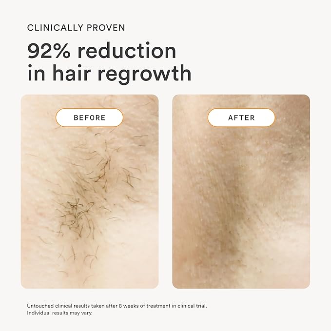 NEW Nood™ Flasher 2.0 Kit — IPL Laser Hair Removal Device for Women & Men — Pain-free & Permanent, Visible Results After First Use & Works Everywhere — Pre & Post IPL Treatment Included — Matte Black-VivaGrace Women