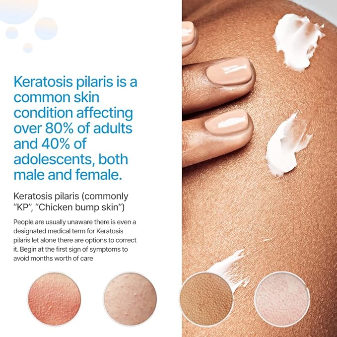 KP Essentials - Keratosis Pilaris Exfoliating Cream - Clear Red Bumps on Thighs and Arms For Confident Clear Skin - 4oz (1 Bottle)-VivaGrace Women