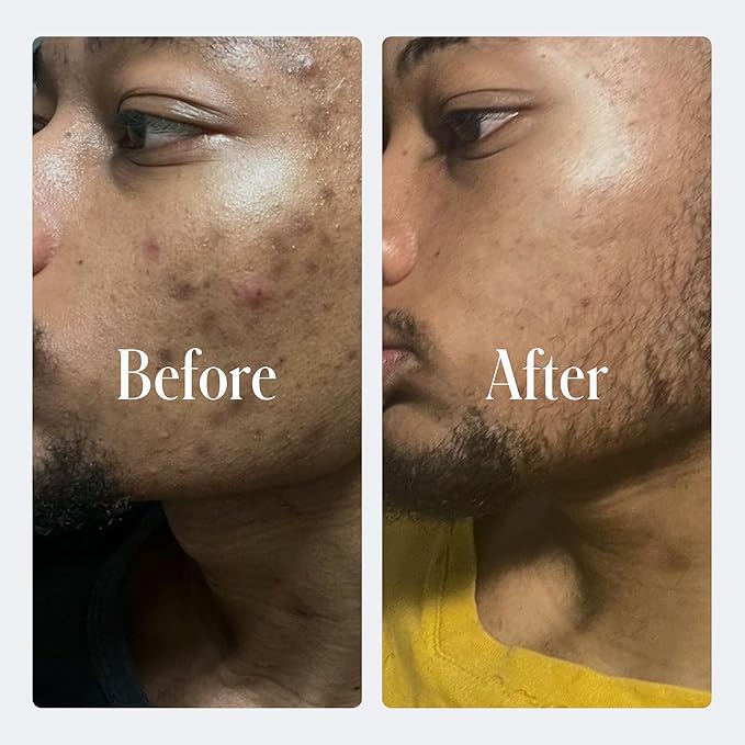 Geologie Clear System | 3-Step Acne Treatment & Skincare Set | Clears Skin Fast | Acne Gel Cleanser, SPF15 Day Cream & .2% Retinol Face Cream For Men & Women | Month 2 / Level 2-VivaGrace Women