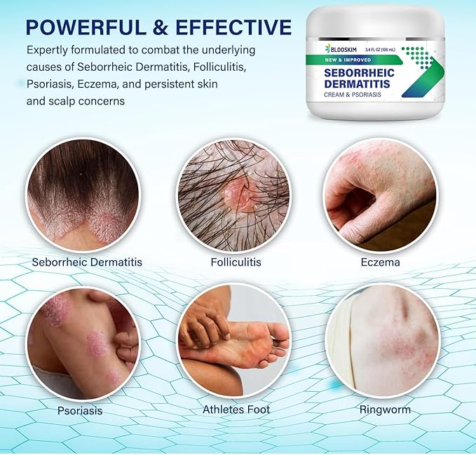 Seborrheic Dermatitis Face Cream – Face, Scalp & Body Moisturizing Treatment for Flaky, Itchy Skin – Daily Lotion for Psoriasis and Dermatitis Relief - Men and Women - 3.4 Fl Oz-VivaGrace Women