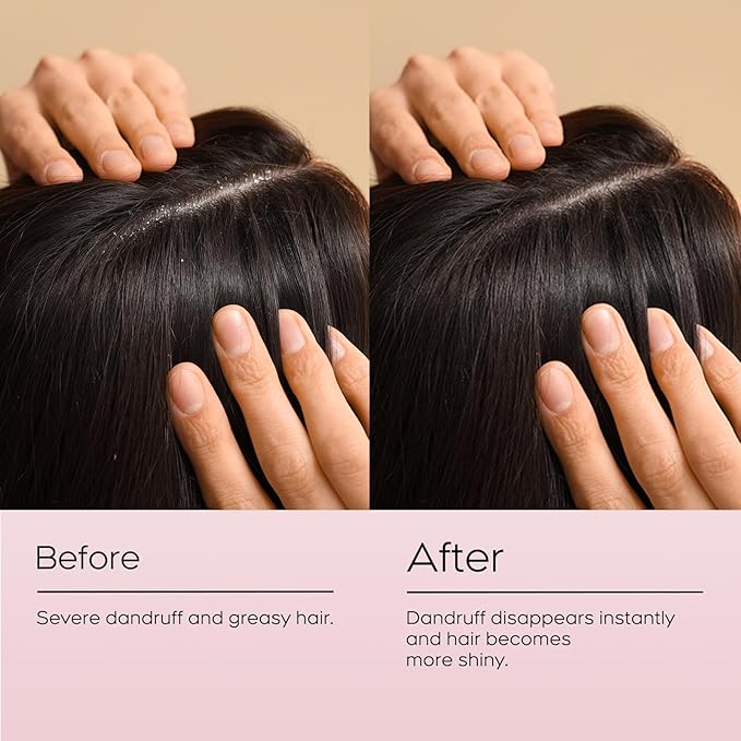 24HR Fast Itch Relief Anti-Fungal Shampoo for Psoriasis, Seborrheic Dermatitis & Folliculitis, Relieves Itchy, Dry Scalp, Sulfate & Paraben Free Anti-Dandruff Shampoo for Men and Women, 8.4 fl oz-VivaGrace Women