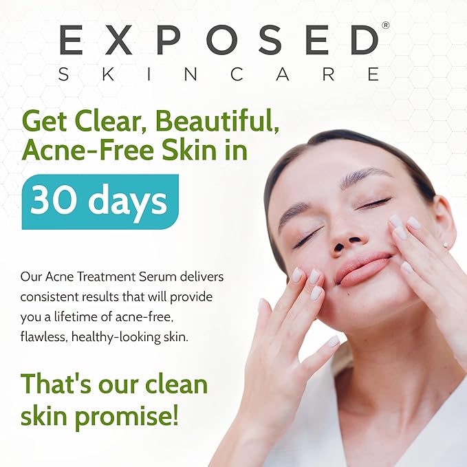 Exposed Skin Care Acne Treatment Serum Step 3 – Quickly Reduces Pimple Size and Redness - 12 Hour Spot Treatment - 3.5% Benzoyl Peroxide, Natural Green Tea & Tea Tree Oil-VivaGrace Women