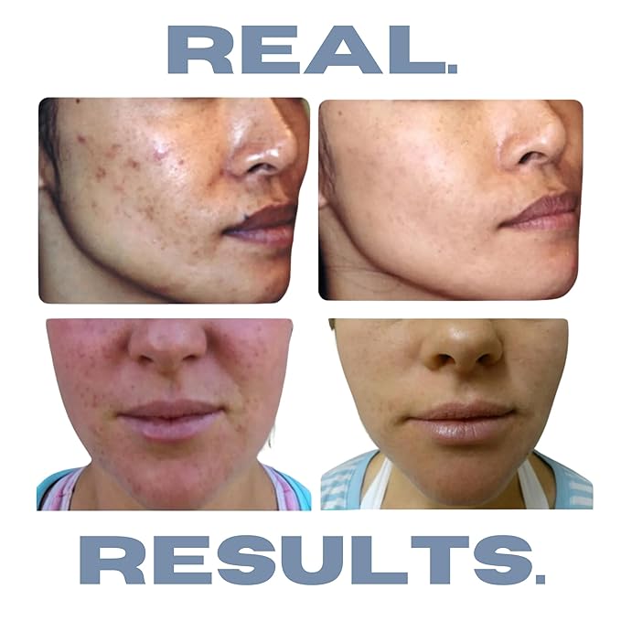 Clarifying Toner for Acne and Blemishes, Face Toner, Facial Toner, Skin Toner, Acne Toner, Toner Oily Skin, Salicylic Acid Toner, Astringent for Face, Toners, 4 Fl Oz-VivaGrace Women