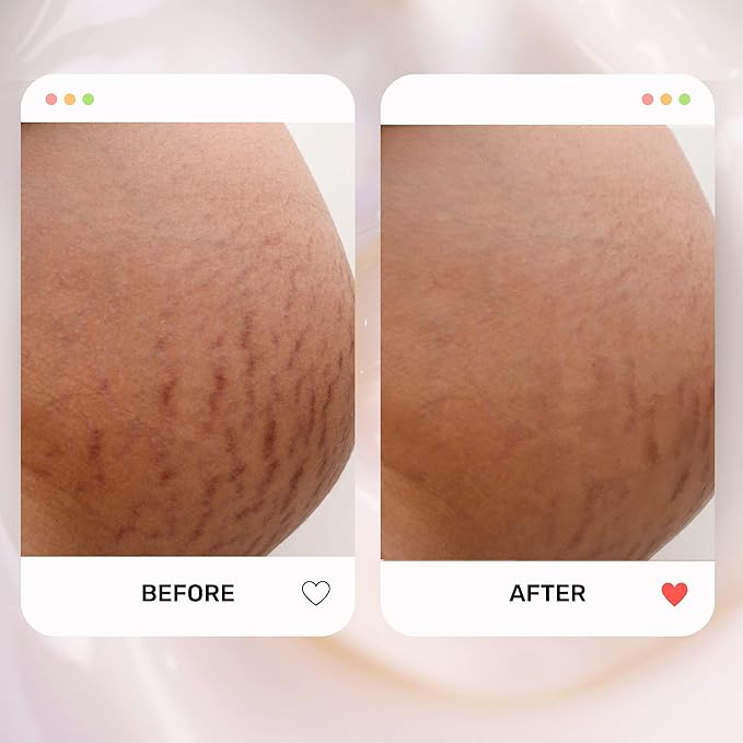 S1 Stretch Mark Cream, 150ml / 5oz, Lightweight Pregnancy Stretch Mark Cream-VivaGrace Women