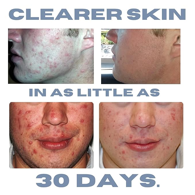 Acne Treatment Kit, Acne Kit, Skin Care Acne, Acne Skin Care Set, Natural Anti-DHT Deluxe Set Sensitive Skin 3-Piece Set, 2-Month Supply-VivaGrace Women