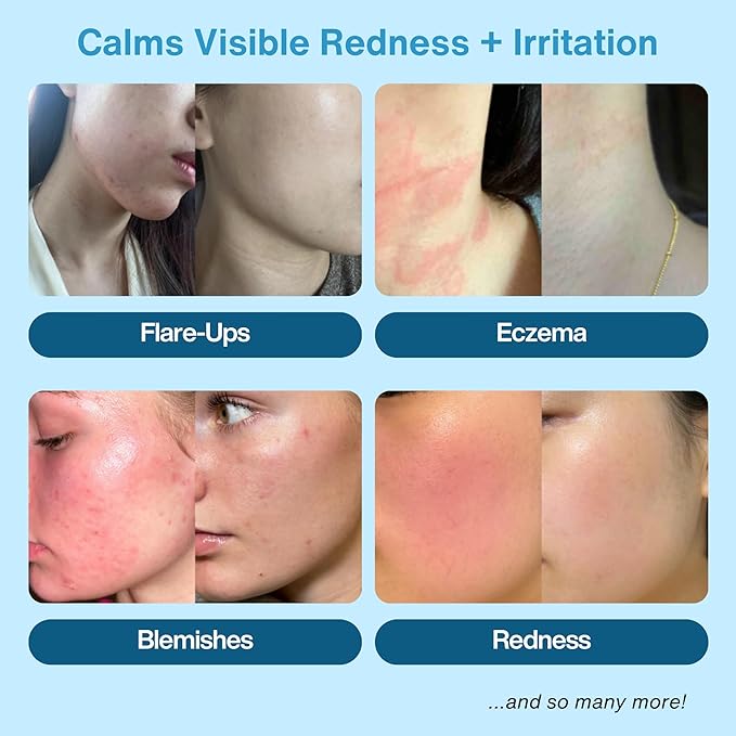 Hypochlorous Acid Spray – HOCl Face & Body Mist for Acne, Eczema & Irritation – Multi-Purpose Skin Repair – Eyelid Cleanser, Post-Workout/Procedure, Scalp & Sensitive Skin (2 oz+6.8 oz)-VivaGrace Women