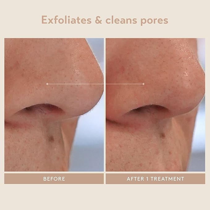 SHANI DARDEN SKIN CARE Triple Acid Peel, 2-Step Exfoliating Face Peel with Mandelic, Lactic & Glycolic Acids, Kaolin Clay Neutralizing Mask & Brush, Helps Improve Dark Spots & Skin Texture, 1.69 fl oz-VivaGrace Women