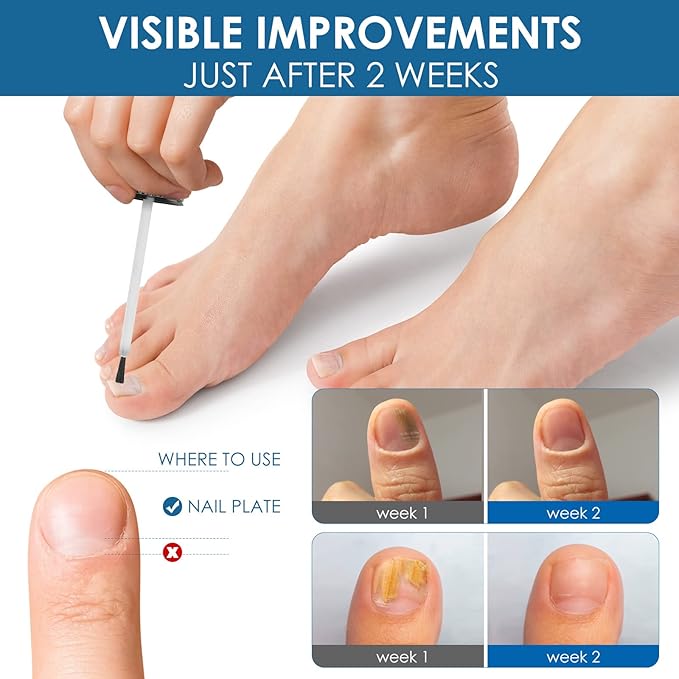 Toenail Repair Treatment, Extra Strength Nail Repair Liquid with Natural Tea Tree Oil Extract, Toenail Repair Solution for Thickened and Ingrow Nails-VivaGrace Women