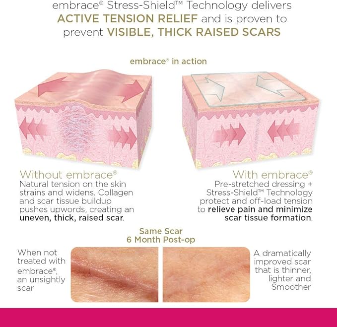 Embrace Active Scar Defense for New Scars, FDA-Cleared Silicone Scar Sheets, 2.4 Inch, Medium, 60 Day Supply (Recommended Treatment)-VivaGrace Women
