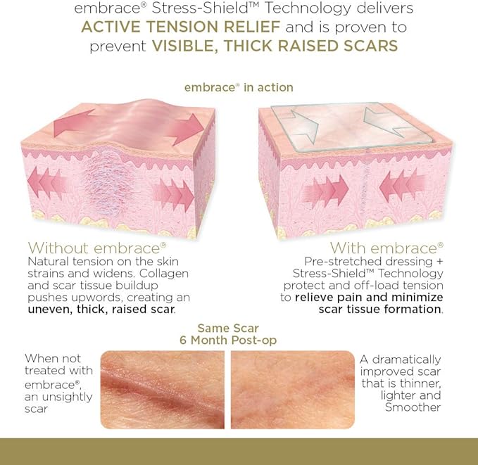 Embrace Scar Treatment, Silicone Sheets for New Scars with Active Scar Defense, Extra Large 6.3 Inch Sheets, 60 Day Supply (Recommended Treatment)-VivaGrace Women