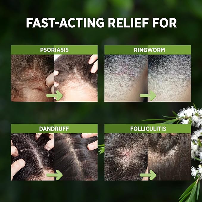 RoyceDerm Tea Tree Scalp Relief Spray: Leave-In Scalp Care for Dry, Flaky, and Itchy Scalp - Tea Tree Oil Formula for Comfort, Hydration, and Balance - Conditioning Support for Women & Men-VivaGrace Women