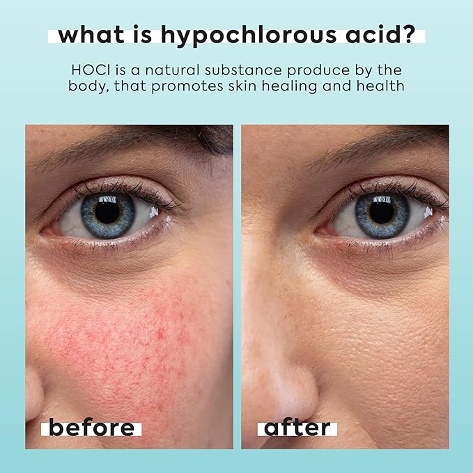 Hypochlorous Acid Spray for Face & Body - Helps Reduce Redness and Breakouts - Travel Size Hypochlorous Spray, Multi-Purpose Topical Facial Skin Repair, pH-Balancing Toner - TSA, Livaclean-VivaGrace Women