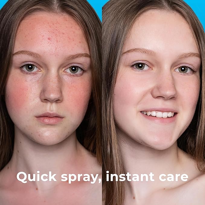 Hypochlorous Acid Spray (8oz, Reduces Acne), Targets Bacteria - HOCL Facial Cleanser Acne Spray for Face, Body, Eczema, Pimples, Breakouts & Overall Skin Recovery (Reduces Redness)-VivaGrace Women