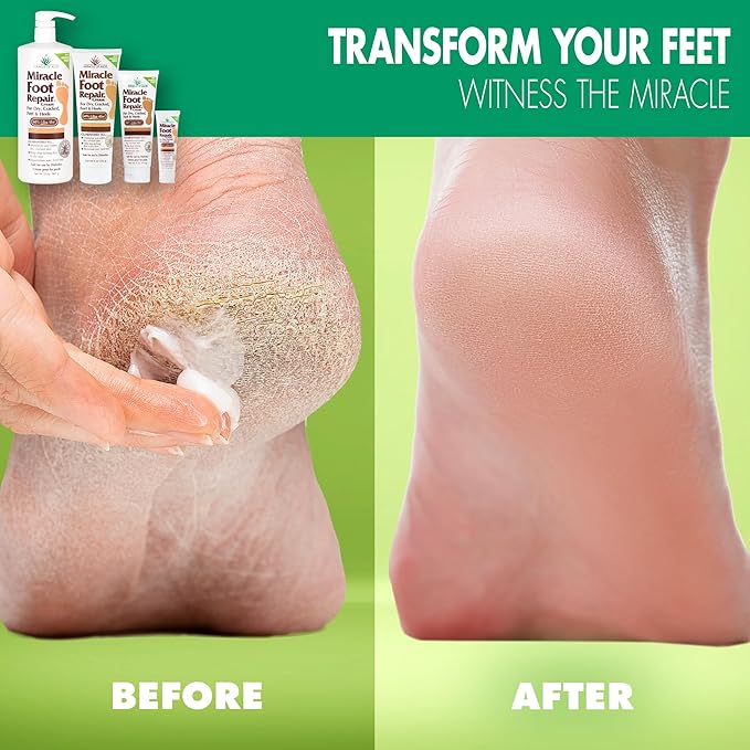 Miracle Foot Repair Cream (32 oz) Repairs Dry Cracked Heels and Feet, 60% Pure UltraAloe Moisturizes, Softens, and Repairs