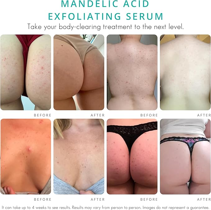 Body Clearing Serum [1 Fl Oz] Level 2 Acne Serum - Advanced Formula for Body Acne, Folliculitis, Back, Butt, Chest, Thighs, Shoulders - Mandelic Acid-VivaGrace Women