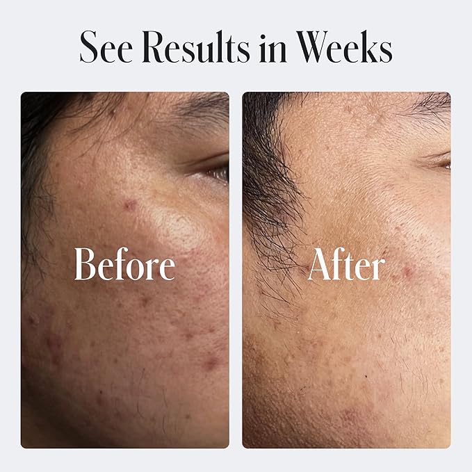 Geologie Skin Repair Moisturizer Face Cream | Clear System Retinol Resurfacing Formula | For Blemish Prone Skin with Niacinamide & Hyaluronic Acid | 60 ML-VivaGrace Women